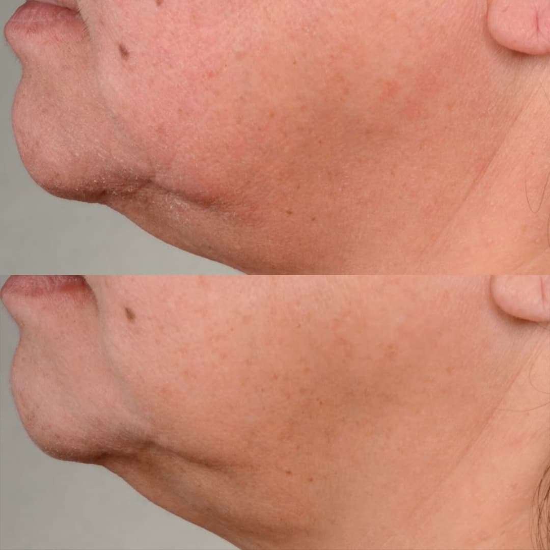 Perricone MD - suero reafirmante con factor de crecimiento de alta potencia - Imagen 3